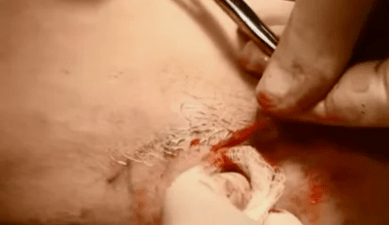 Tipos de operacións para eliminar varices