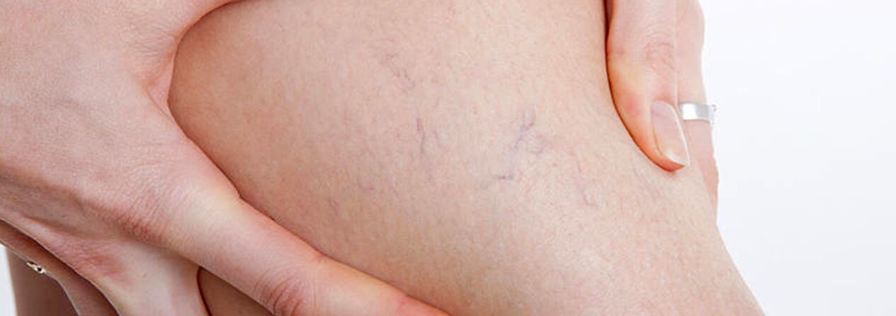 Arañas con varices