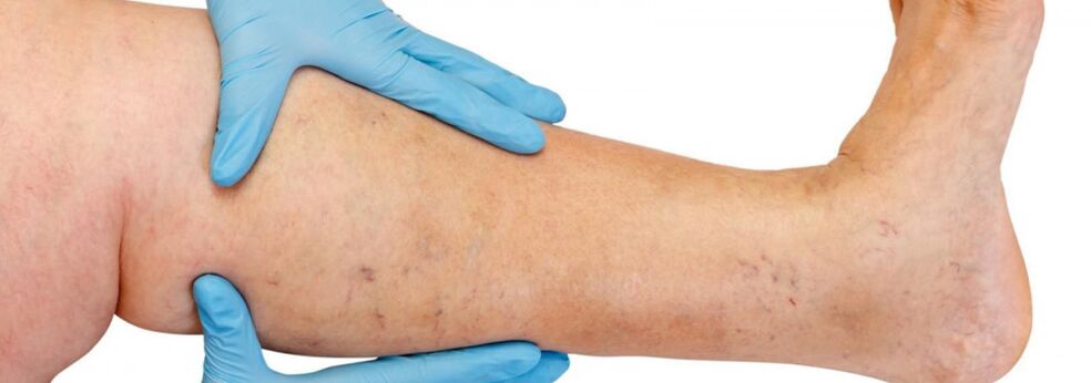 Varices na perna